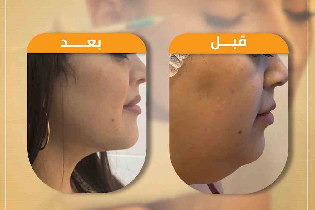 Cases before and after النحت الأيوني without surgery for the glandular area