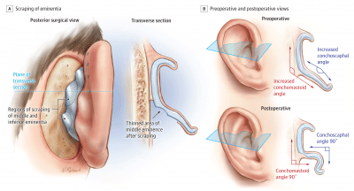 ear plastic surgery cyprus limassol nicosia