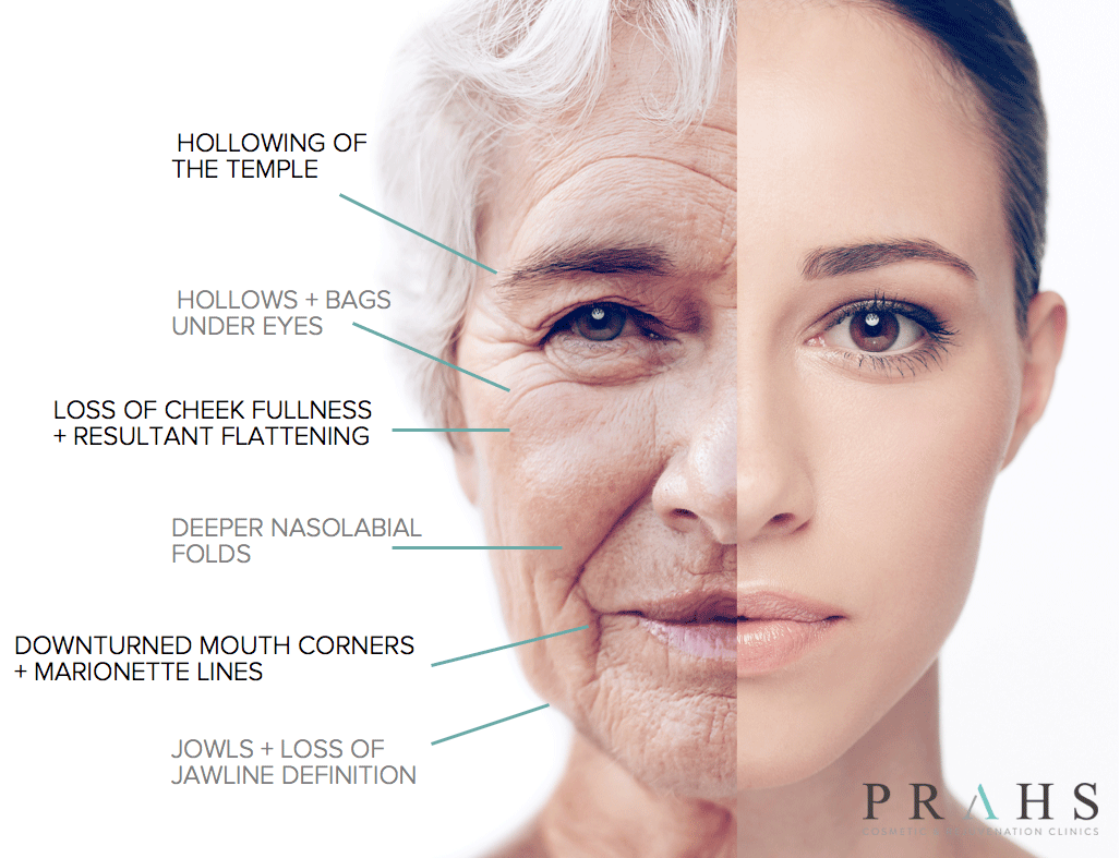 face-aging-diagram-dermal-facial-fillers-PRAHS-Cosmetic-Clinics-Brisbane-and-Ipswich