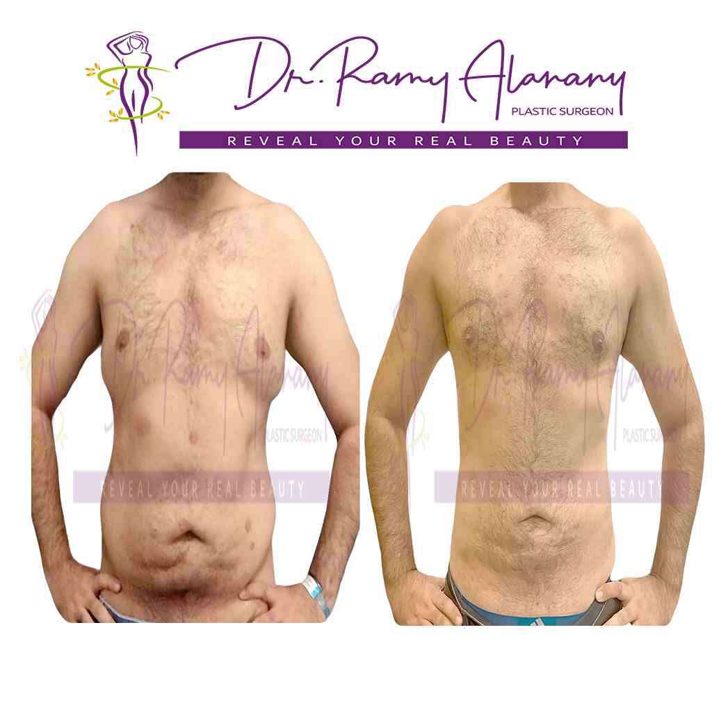 Body sculpting and the latest development of vaser liposuction - liposuction process - liposuction of the abdomen and sides