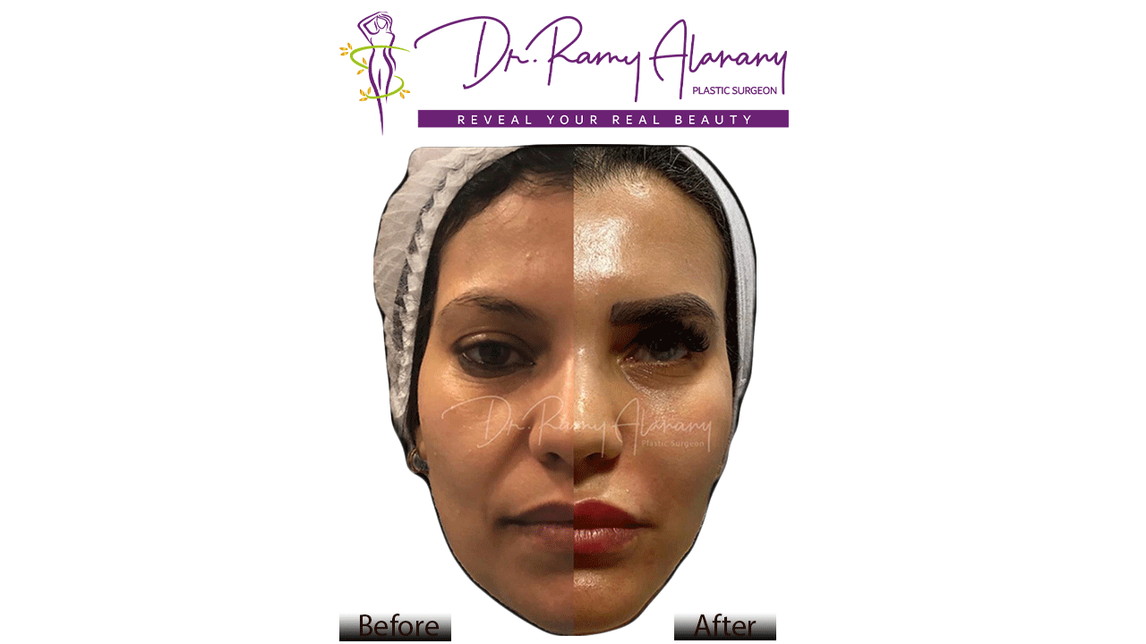 حقن الفيلر المدمج و ما هو الفيلر Dr Ramy Al Anany د رامي العناني جراح تجميل