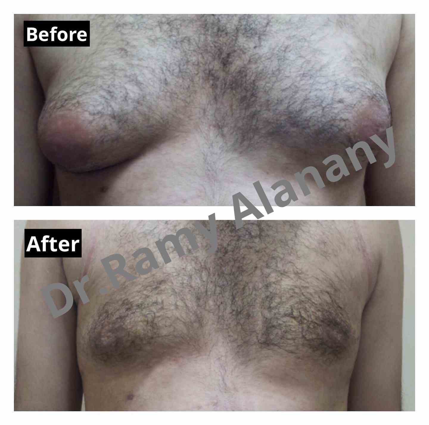 Treatment of gynecomastia in men causes, treatment and degrees of gynecomastia in men - treatment of breast enlargement in men