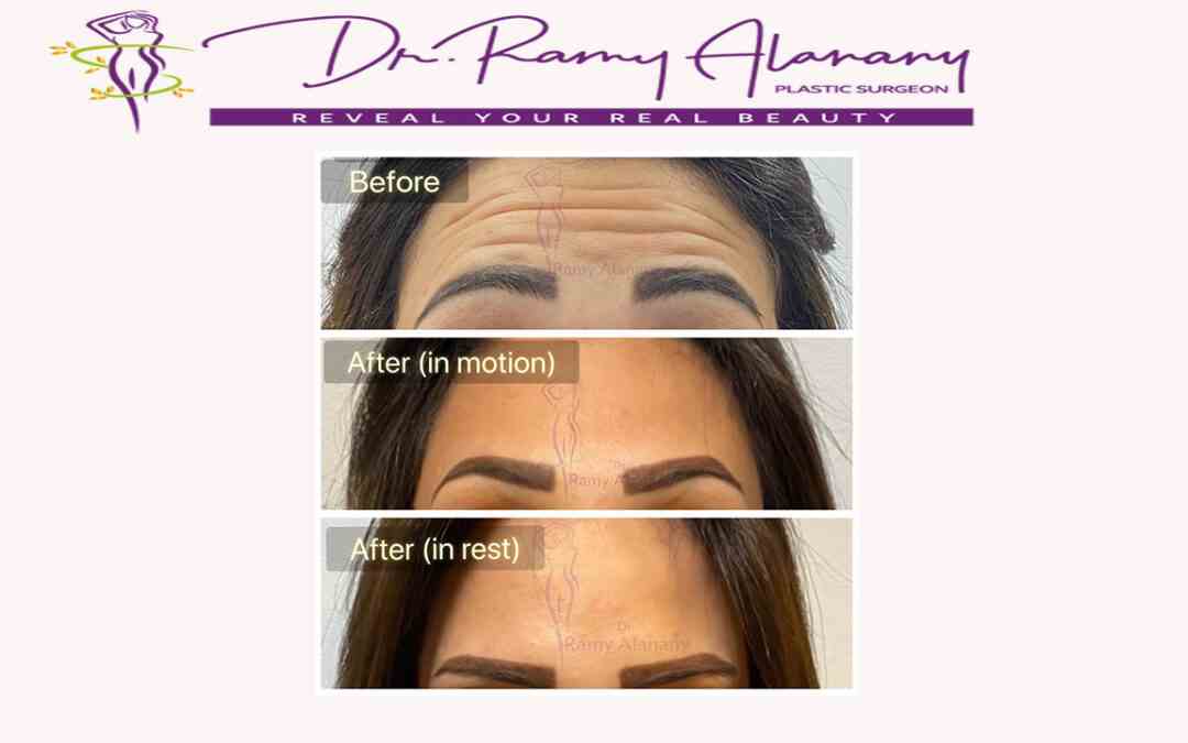 Cases before and after Botox injections by Dr. Ramy Al Anany