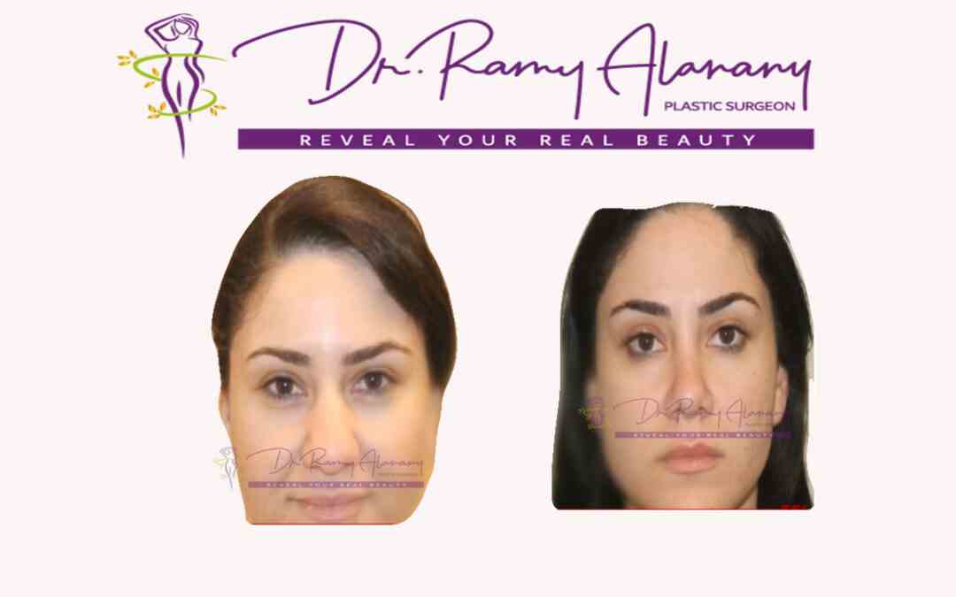 Cases before and after rhinoplasty by Dr. Ramy Al Anany