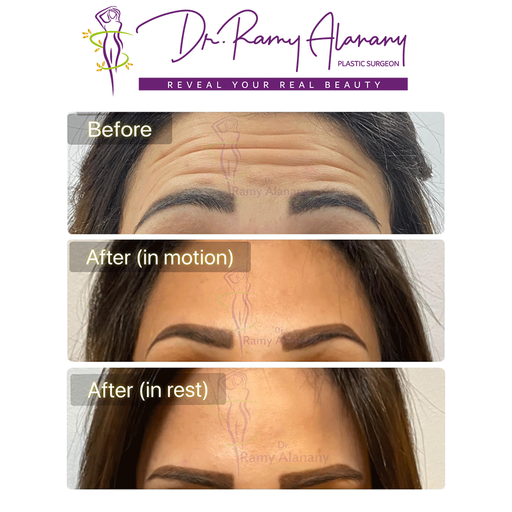What is Botox: Botox injections is a facial wrinkle treatment and helps remove wrinkles around the eyes in 5 minutes