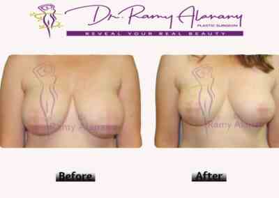 عمليات تجميل الثدي - عملية شد الصدر - عملية شد الثدي - طريقة تصغير الثدي - درجات ترهل الثدي