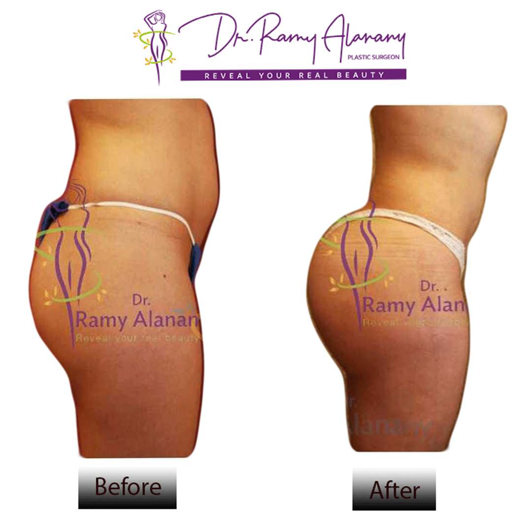 To quickly enlarge the buttocks (buttocks augmentation) - Brazilian butt to raise the butt without exercises to enlarge the buttocks and rotate it
