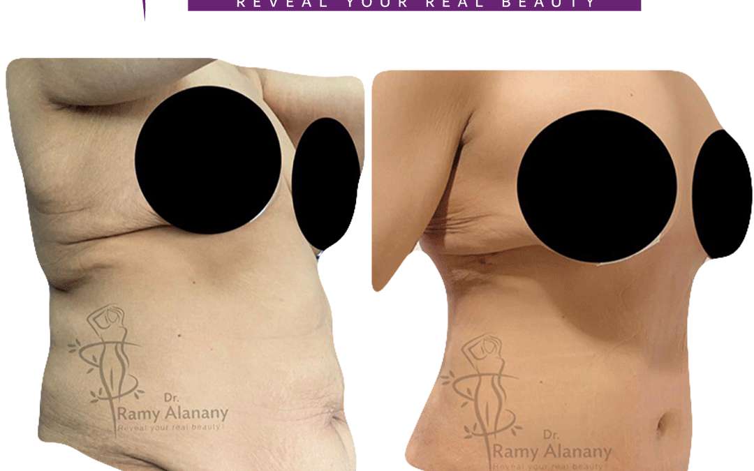 Before and after pictures of tummy tuck cases – tummy tuck