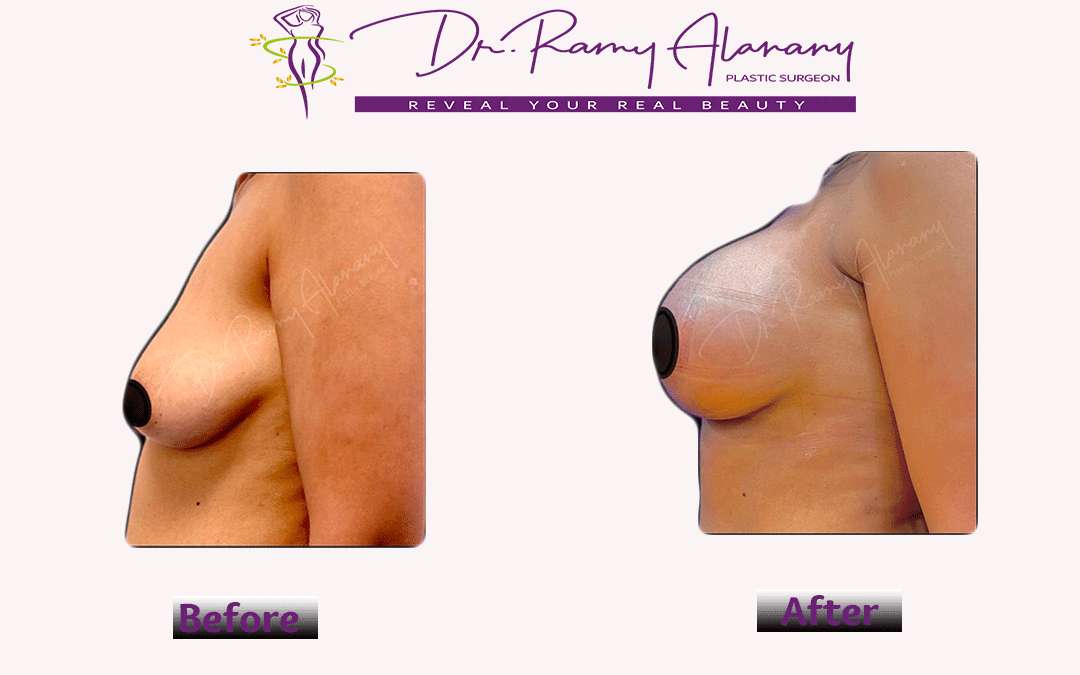 Cases before and after breast augmentation